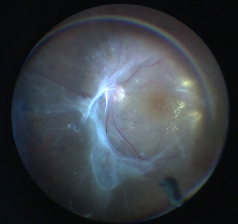 Diabetik Retinopati