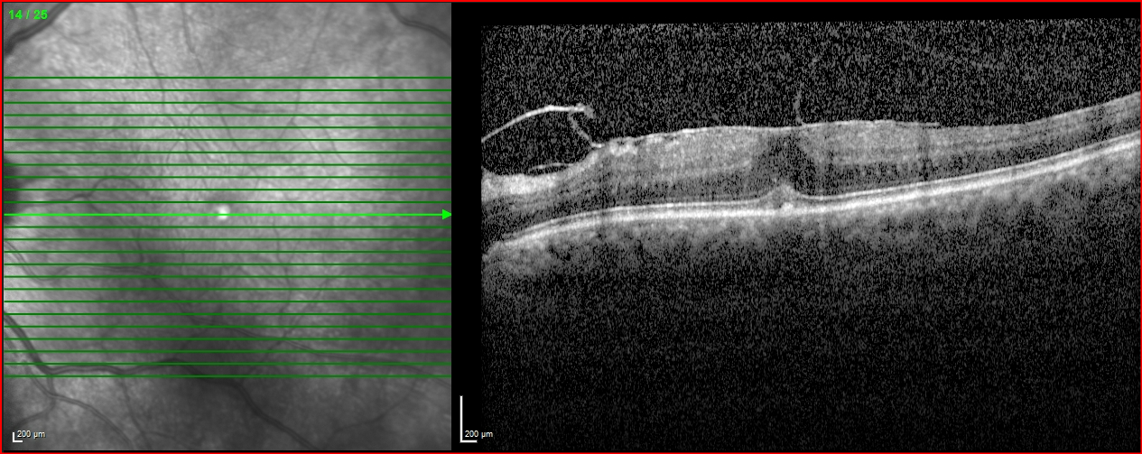 Epiretinal Membran