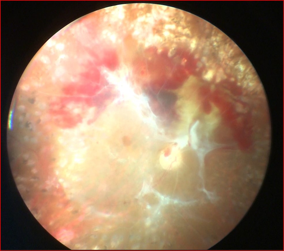 Diabetik Retinopati