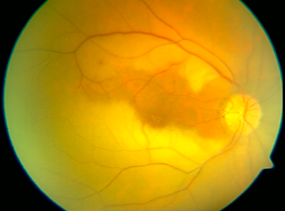 Retinal Arter Tıkanıklığı