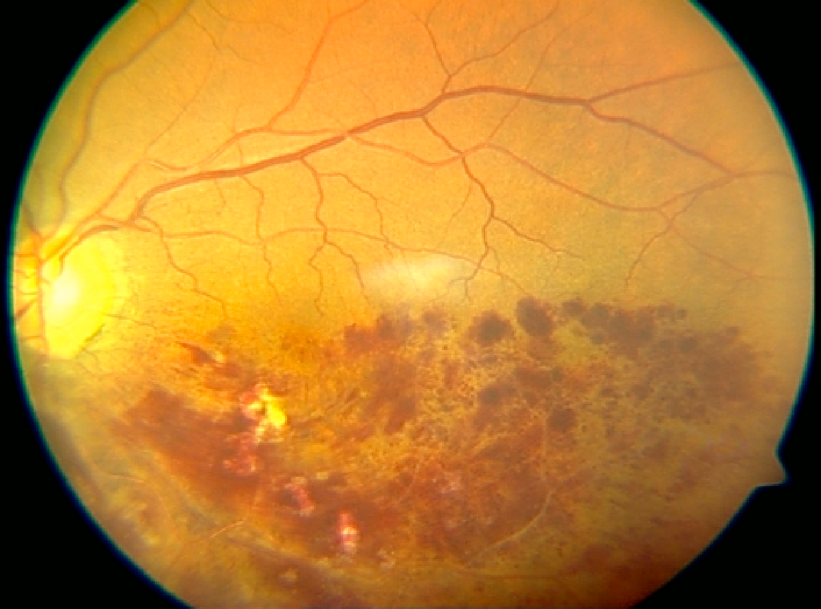 Retinal Ven Tıkanıklığı